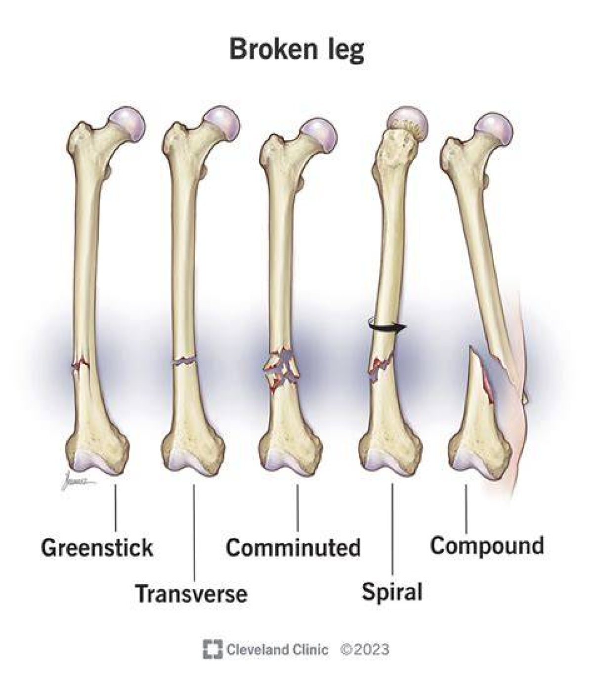 Claims Five: Why Does a Broken Leg Mean the End for a Horse? | Horse Racing