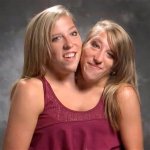 Conjoined Twins Abby and Brittany Are Pregnant: a Medical Miracle