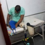 Mason Leg Amputated Surgery: Understanding the Procedure and Recovery